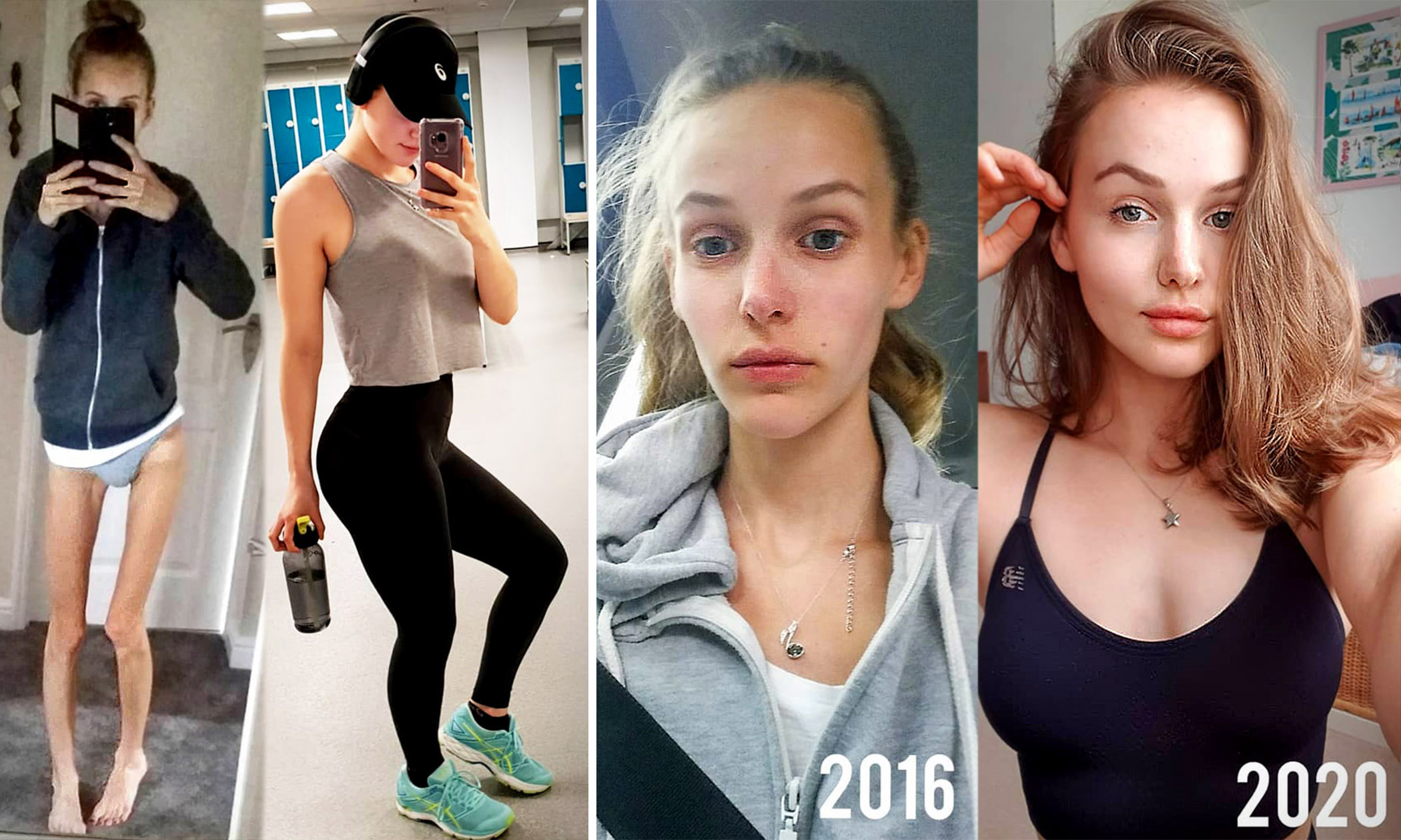 Anorexic Teen Was Rushed To EmergencyBecame Fitness Guru After Making Incredible Recovery